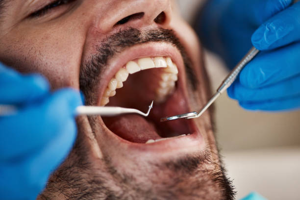 Best Knocked-Out Tooth (Avulsed Tooth) Treatment in Bridgeport, NY